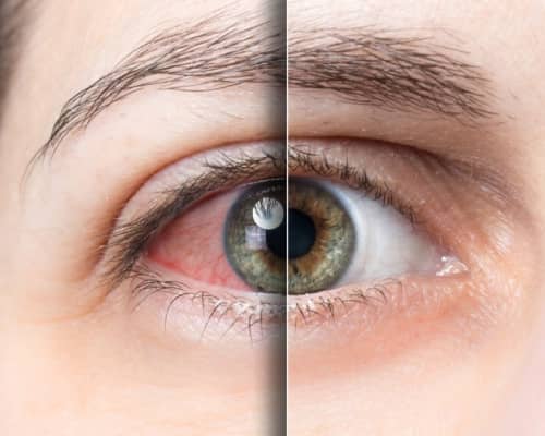 Red Eye & Emergency Eye Exams